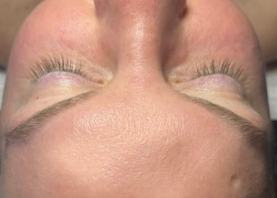 Hydrafacials Before