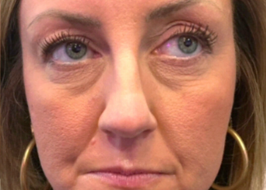 Sculptra Before