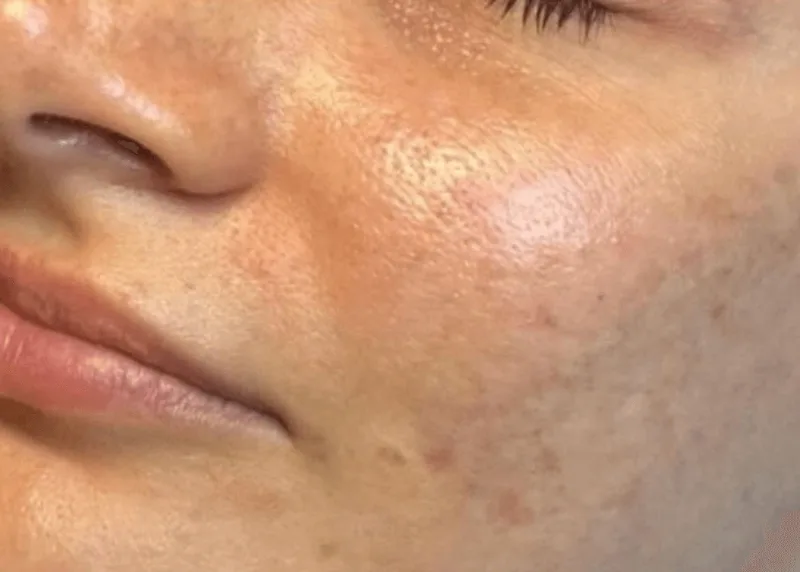 Skinpen Microneedling Before